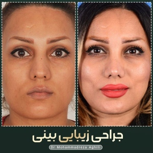 rhinoplasty-51