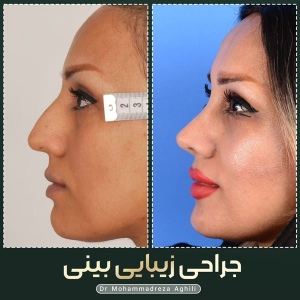 rhinoplasty-52
