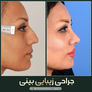 rhinoplasty-53