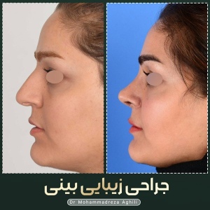 rhinoplasty-54