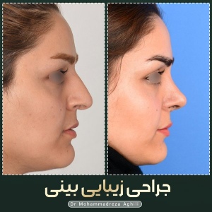 rhinoplasty-55