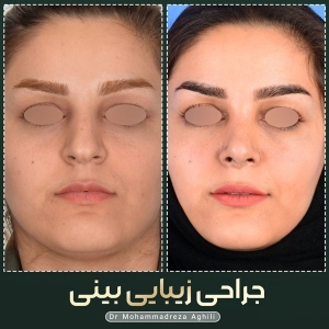rhinoplasty-56