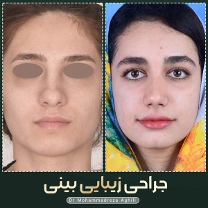 rhinoplasty-57