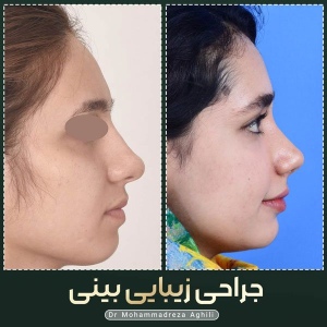 rhinoplasty-58