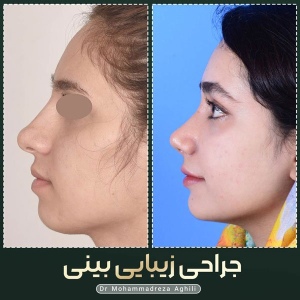 rhinoplasty-59