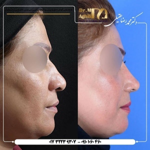 rhinoplasty-6-