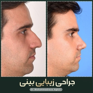 rhinoplasty-60