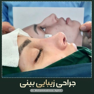 rhinoplasty-61