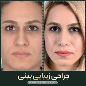 rhinoplasty-62