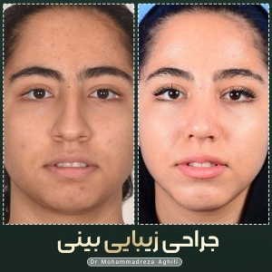 rhinoplasty-63