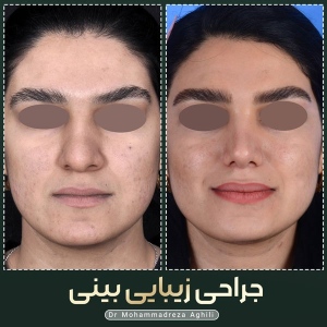 rhinoplasty-64