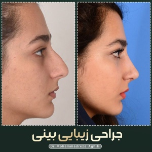 rhinoplasty-65