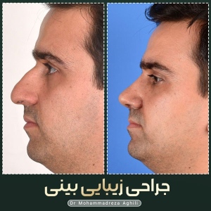 rhinoplasty-66