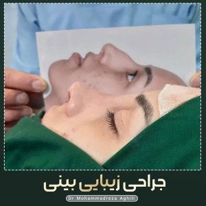 rhinoplasty-67