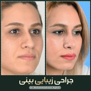 rhinoplasty-68