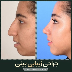 rhinoplasty-69