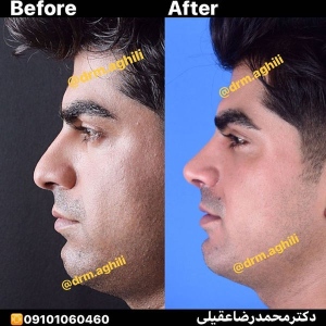 rhinoplasty-7-