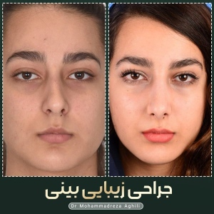 rhinoplasty-70