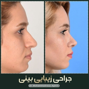 rhinoplasty-71