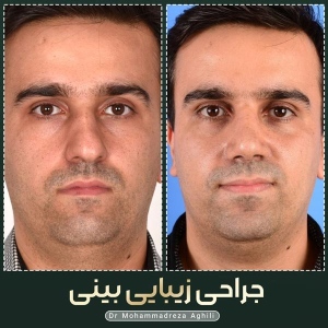 rhinoplasty-72