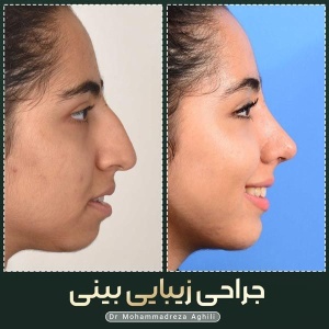 rhinoplasty-73