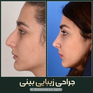 rhinoplasty-74