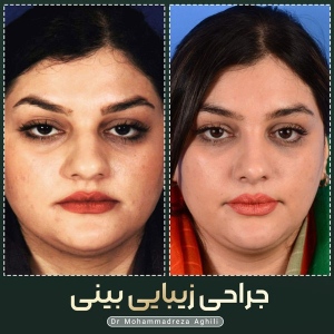 rhinoplasty-75