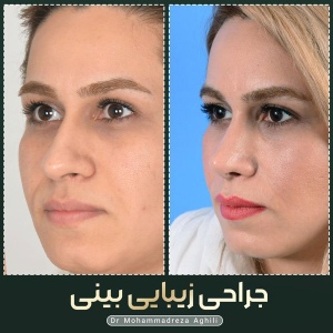 rhinoplasty-76