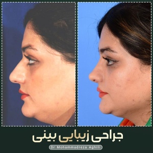 rhinoplasty-77