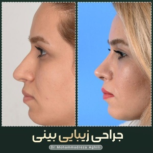 rhinoplasty-78