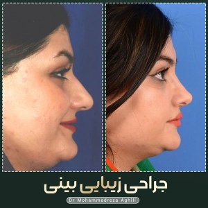 rhinoplasty-79