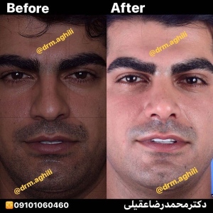 rhinoplasty-8-