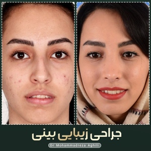 rhinoplasty-80