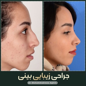 rhinoplasty-81