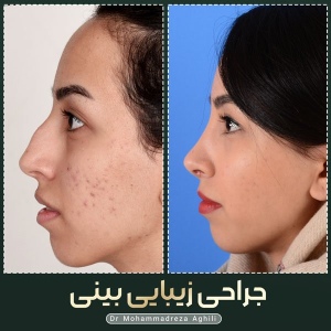 rhinoplasty-82