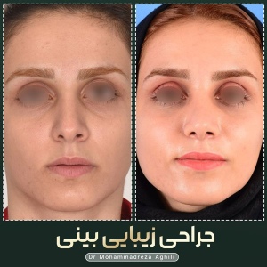 rhinoplasty-83