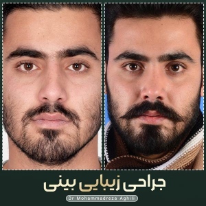 rhinoplasty-84