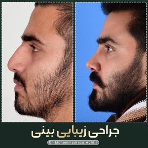 rhinoplasty-86