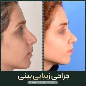 rhinoplasty-87