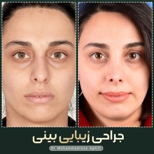 rhinoplasty-88