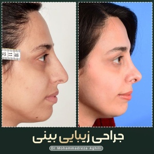 rhinoplasty-89