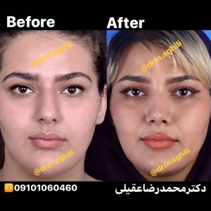 rhinoplasty-9-