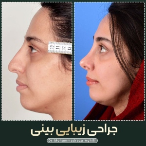rhinoplasty-90