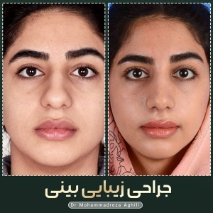 rhinoplasty-91