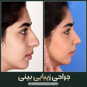 rhinoplasty-92