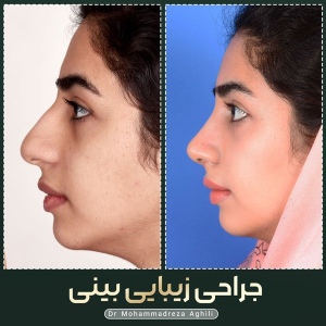 rhinoplasty-93