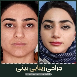 rhinoplasty-94