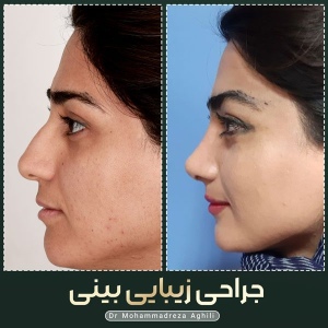rhinoplasty-95