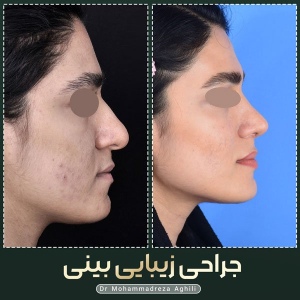 rhinoplasty-96