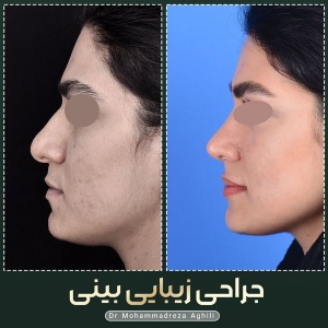 rhinoplasty-97